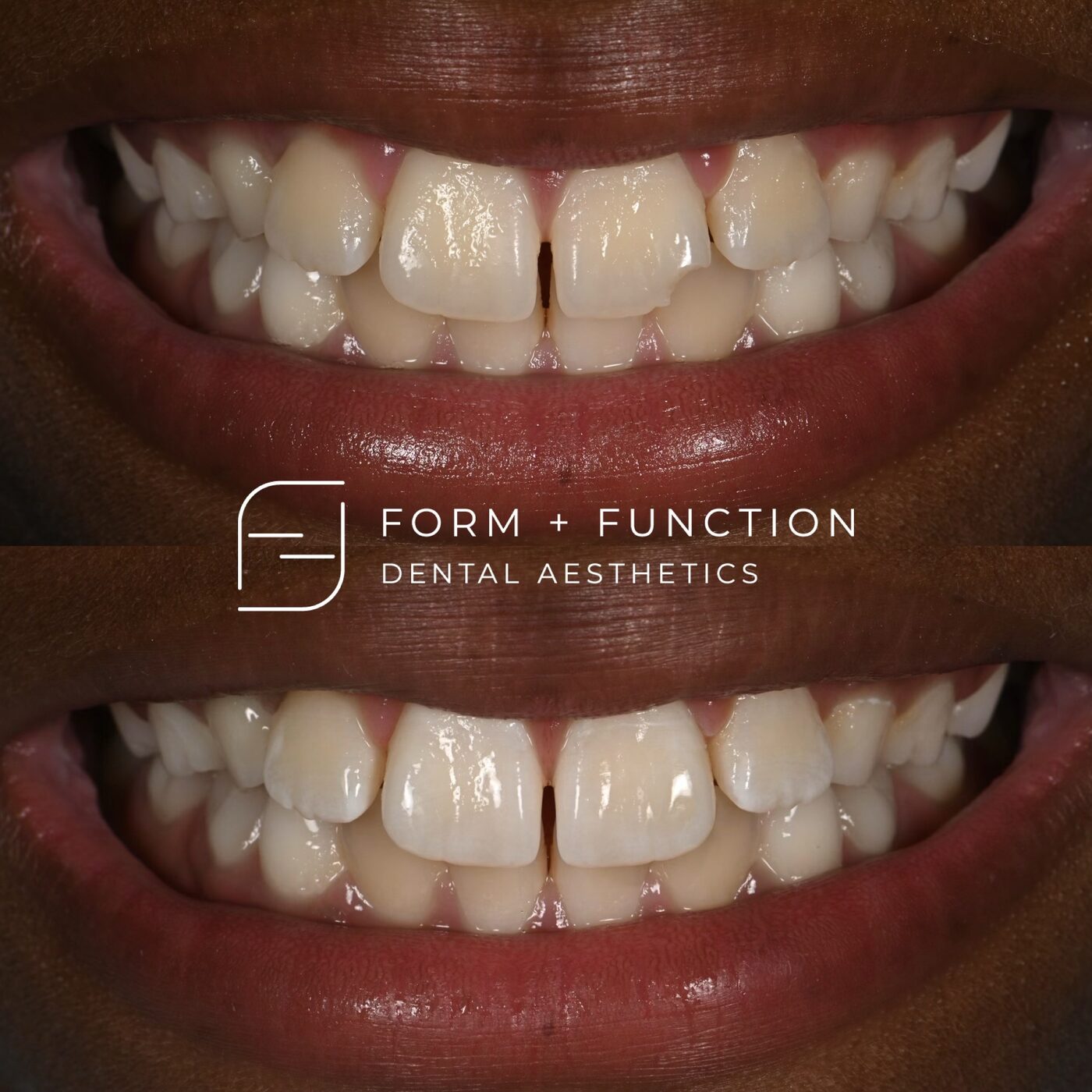 Before and after composite bonding, shaped directly onto the teeth in a single visit. Treated by Kevin Tan, DDS in Las Vegas.