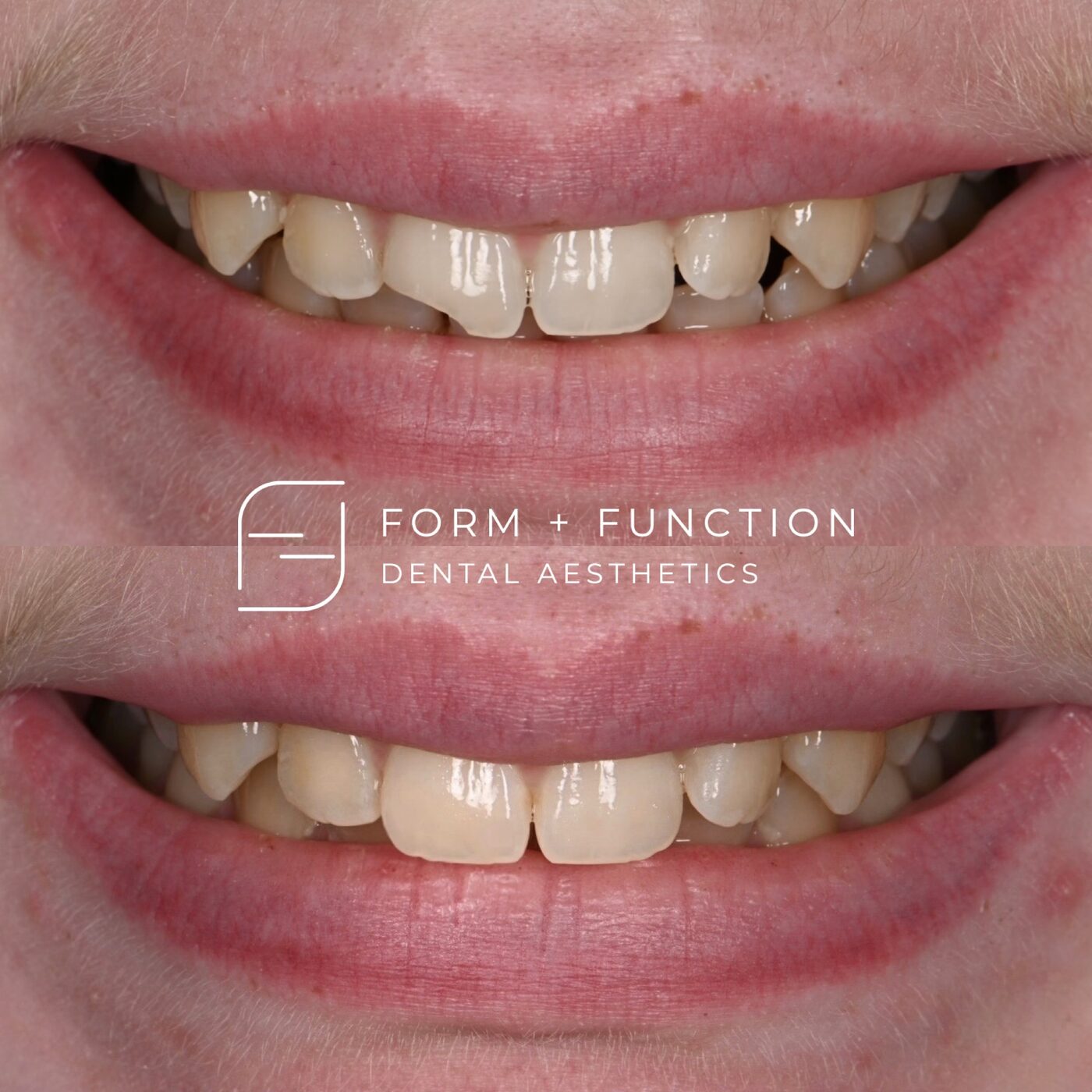Before and after composite bonding, closing the gaps and rebuilding the worn edges. Treated by Kevin Tan, DDS in Las Vegas.
