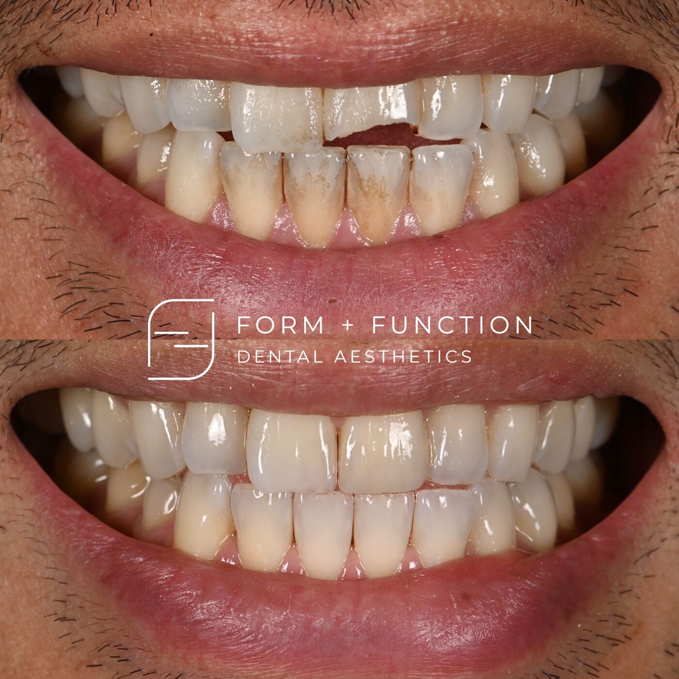 Before and after composite bonding, with no enamel removed. Treated by Kevin Tan, DDS in Las Vegas.