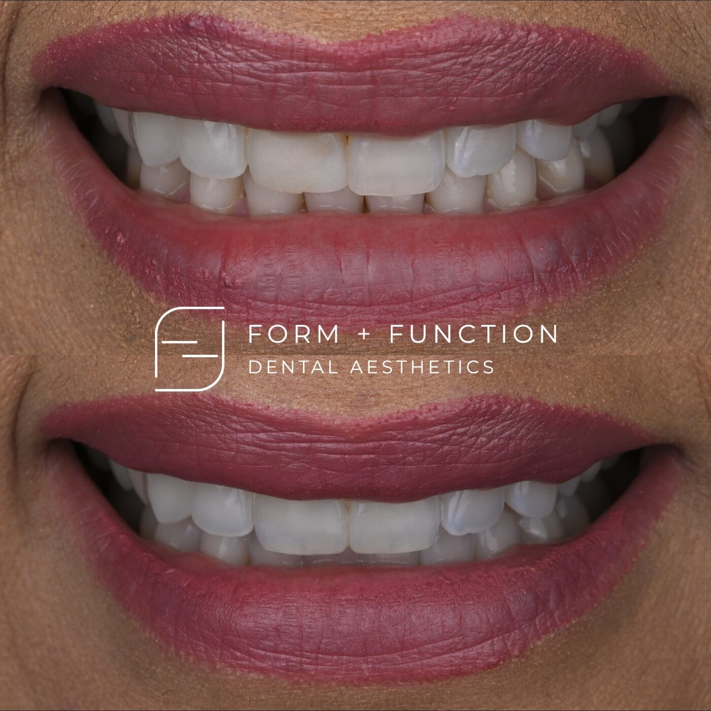 Before and after composite bonding, evening out the width of the front teeth. Treated by Kevin Tan, DDS in Las Vegas.