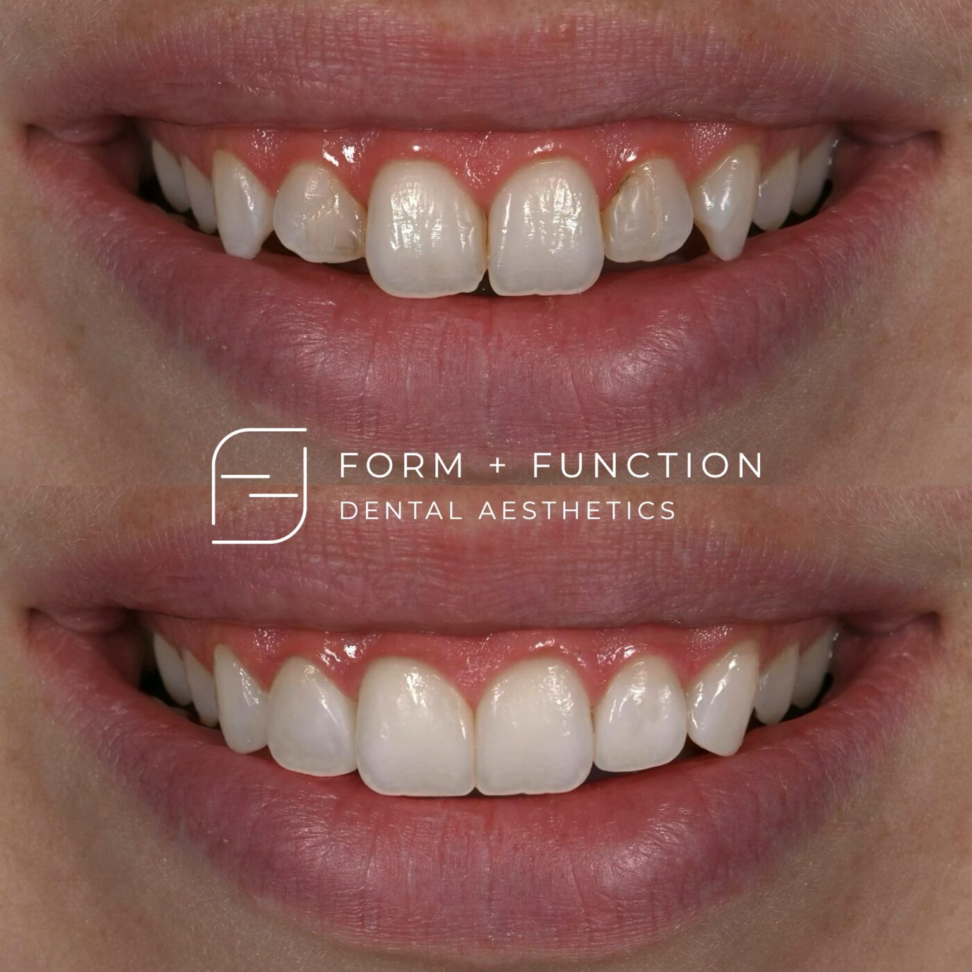 Before and after four composite veneers with a gum lift, done in composite rather than porcelain. Treated by Kevin Tan, DDS in Las Vegas.