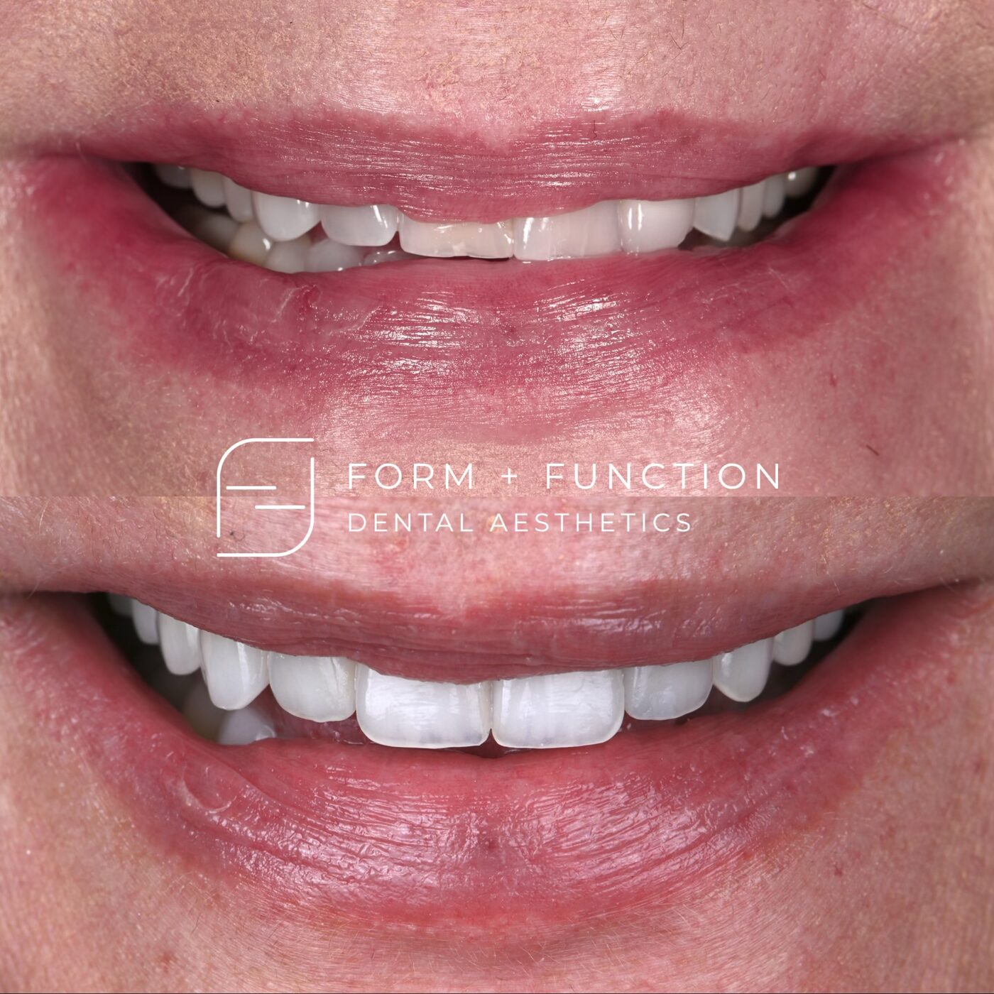 Before and after a full mouth rehabilitation planned alongside the airway and the bite, not around the front teeth alone. Treated by Kevin Tan, DDS in Las Vegas.