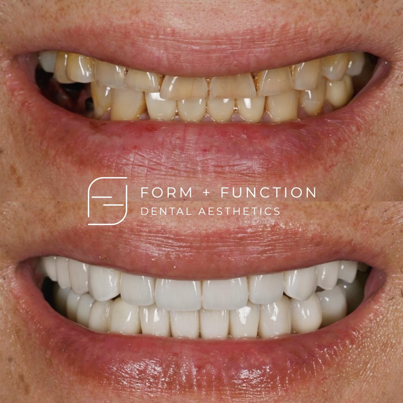 Before and after a full mouth rehabilitation including implants, restored to match the natural teeth around them. Treated by Kevin Tan, DDS in Las Vegas.