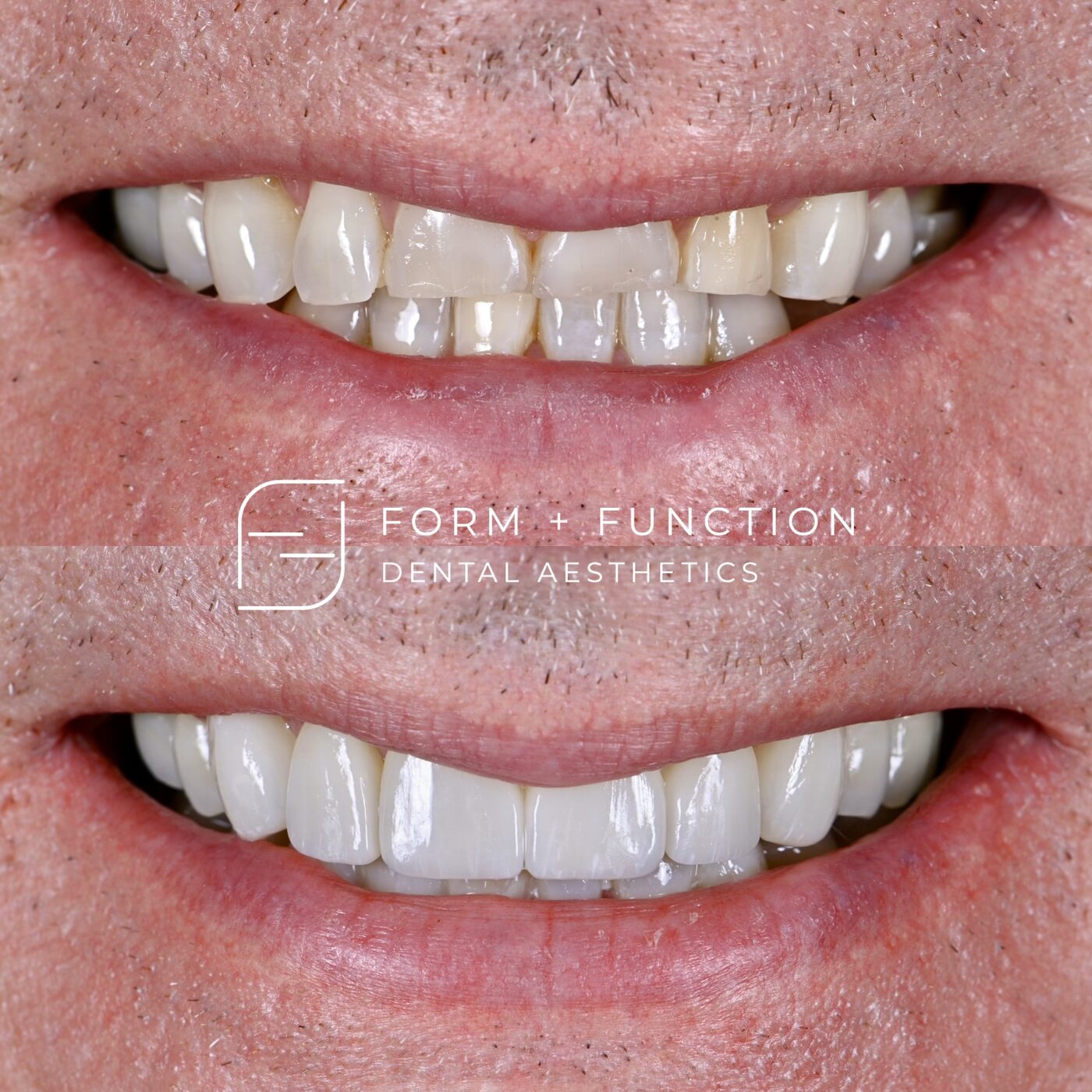 Before and after a full mouth rehabilitation, planned as one result rather than tooth by tooth. Treated by Kevin Tan, DDS in Las Vegas.