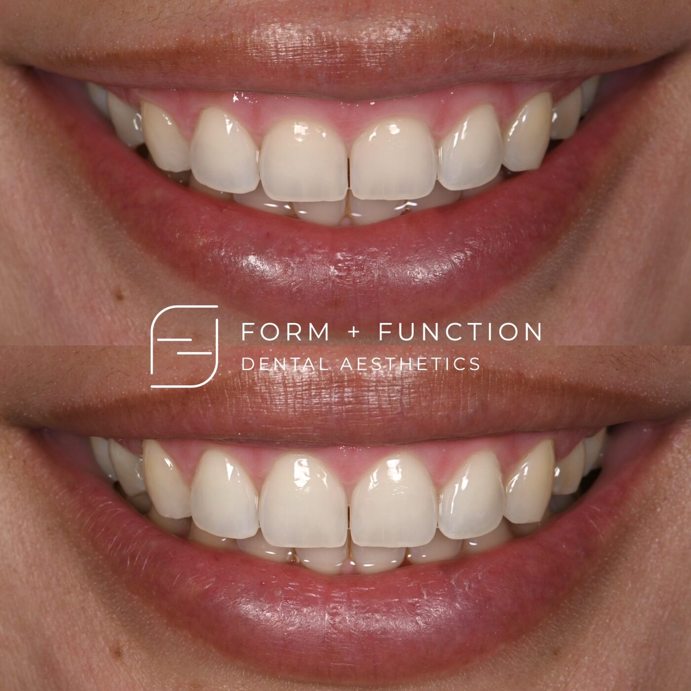 Before and after a gum lift on its own, where the teeth were the right shape and the gum line was not. Treated by Kevin Tan, DDS in Las Vegas.