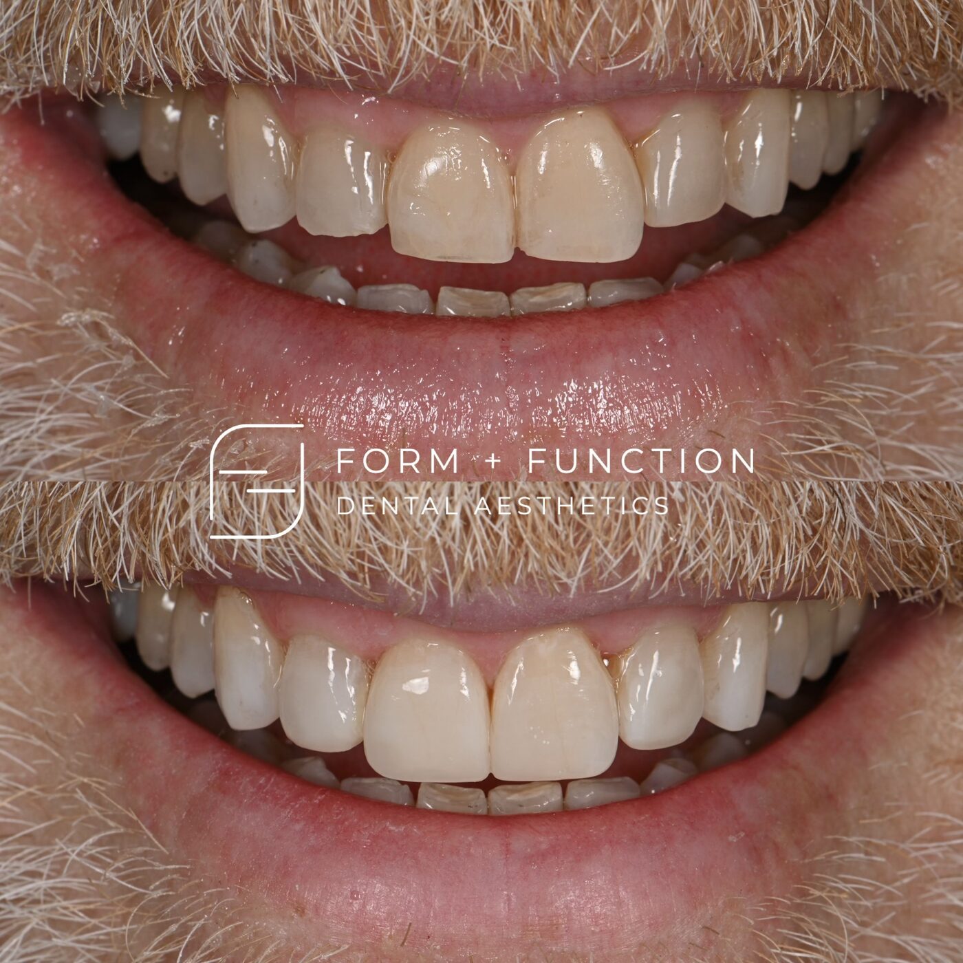 Before and after clear aligners to move the teeth into position, then composite bonding to finish the shape. Treated by Kevin Tan, DDS in Las Vegas.