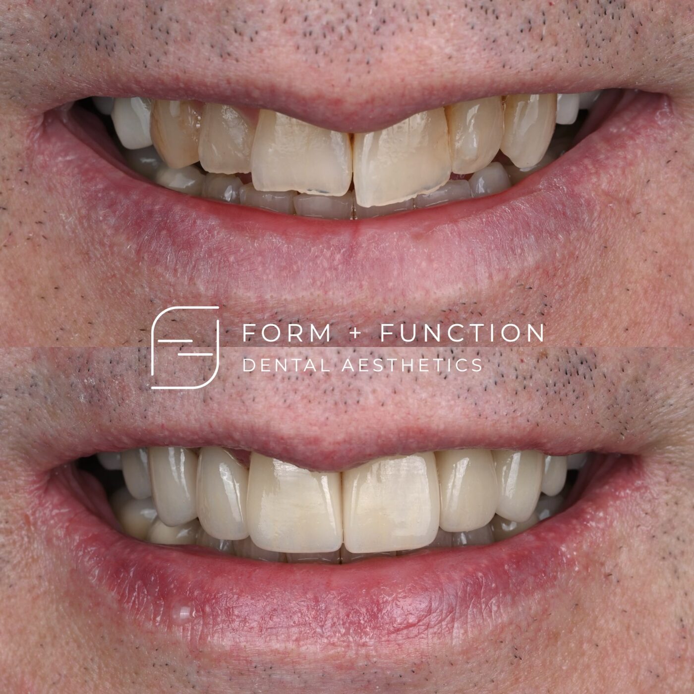Before and after eight porcelain crowns, restoring strength as well as appearance. Treated by Kevin Tan, DDS in Las Vegas.