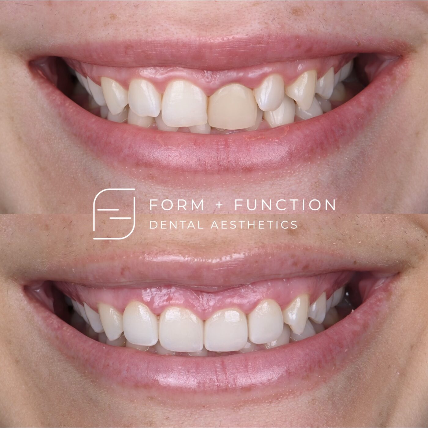 Before and after four porcelain veneers with a gum lift. A smaller case, treating only the teeth that needed it. Treated by Kevin Tan, DDS in Las Vegas.