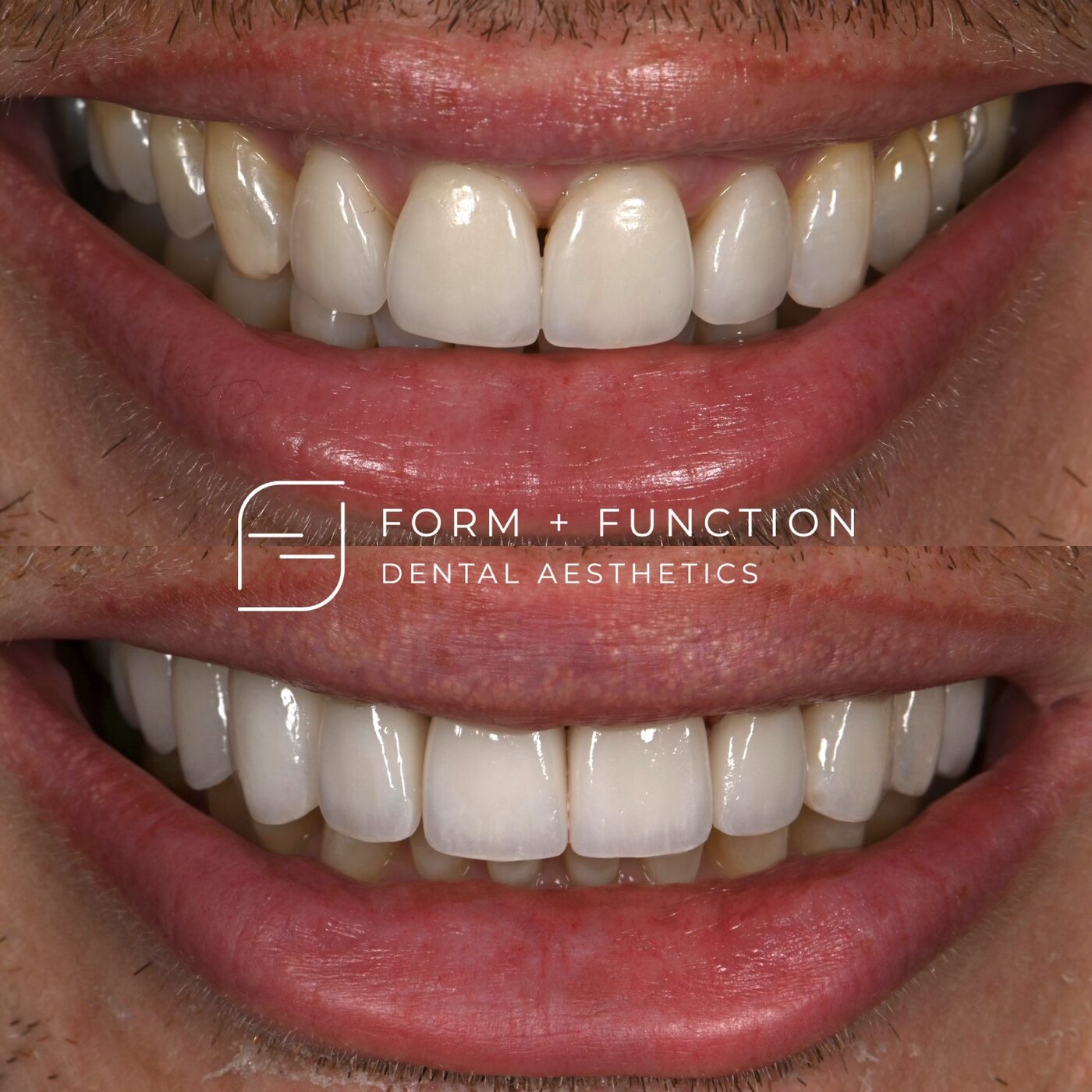 Before and after ten porcelain veneers with a gum lift, so the teeth and the gum line were corrected together. Treated by Kevin Tan, DDS in Las Vegas.