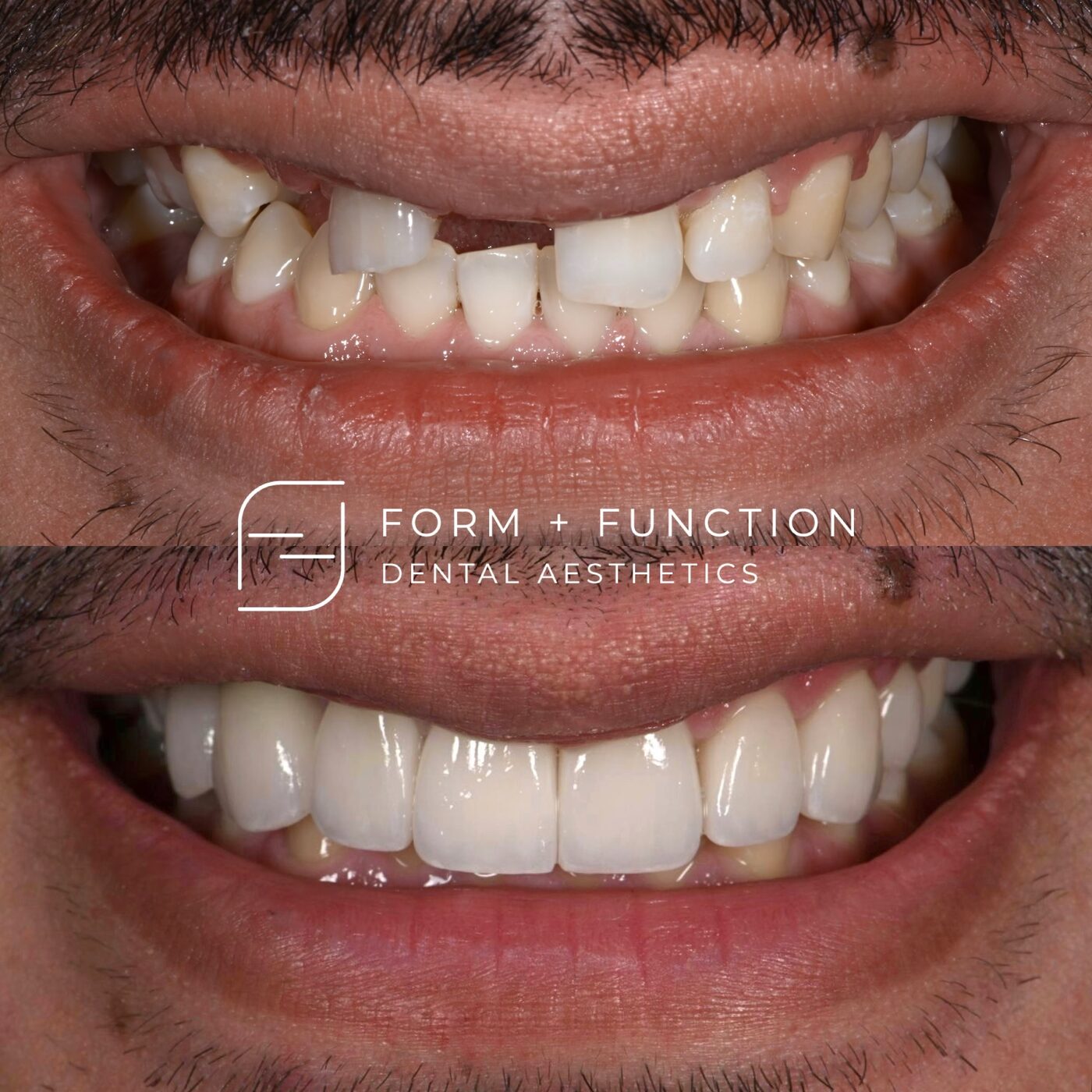Before and after eight porcelain veneers alongside an implant crown, matched to the veneers beside it. Treated by Kevin Tan, DDS in Las Vegas.