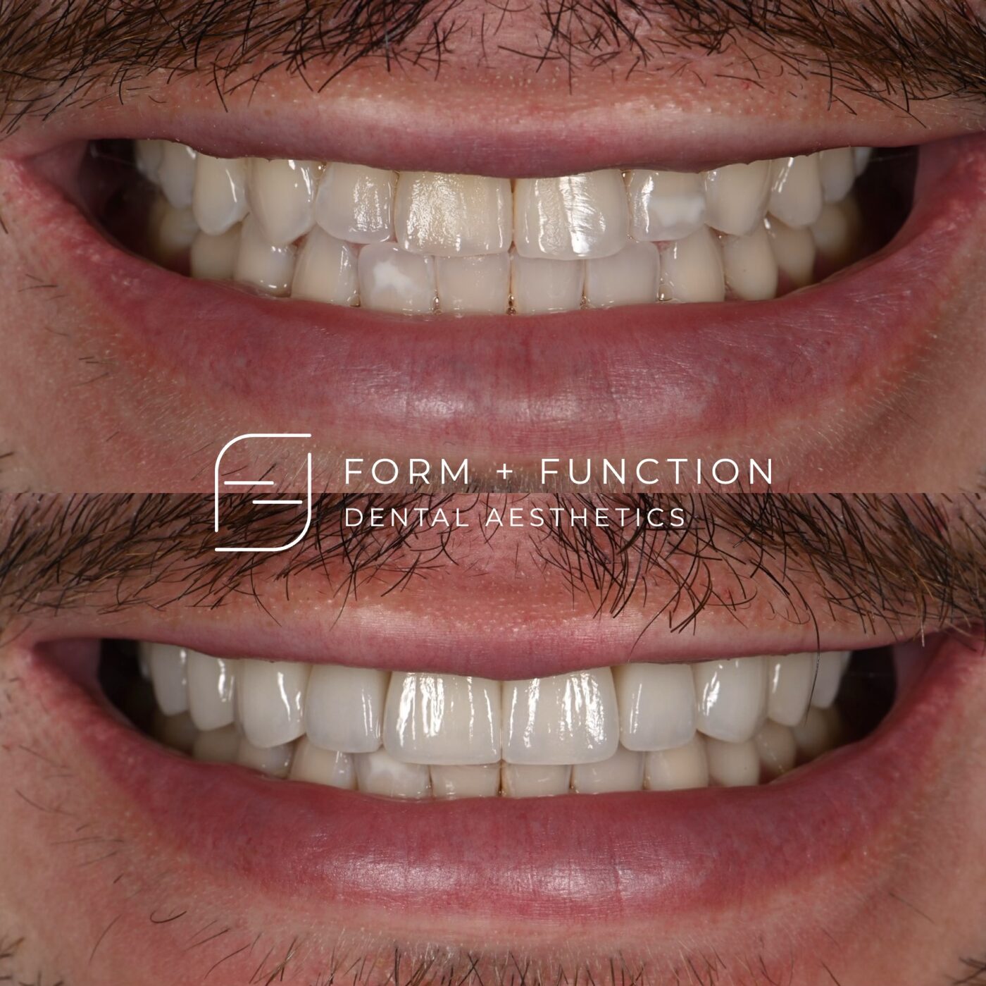 Before and after ten porcelain veneers, planned around the smile line and the shape of the face. Treated by Kevin Tan, DDS in Las Vegas.