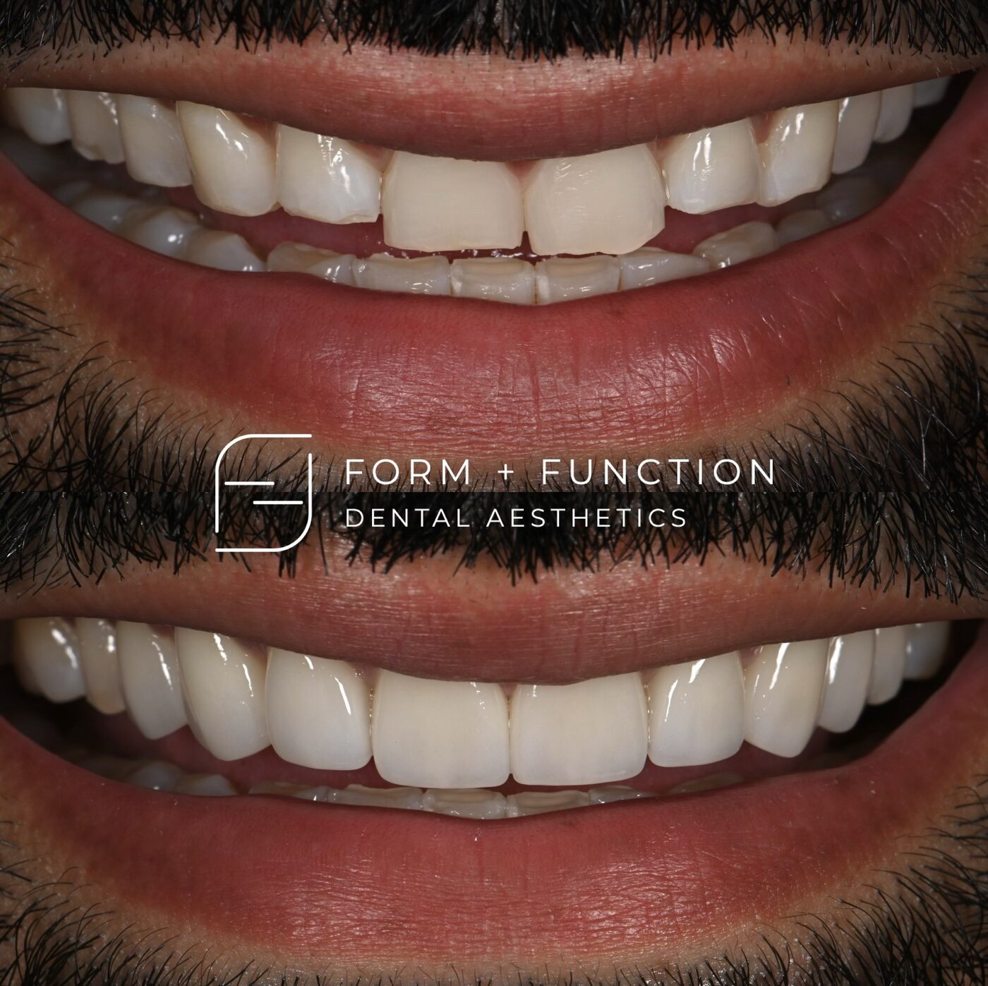 Before and after eight porcelain veneers, closing the spacing and evening out the edges. Treated by Kevin Tan, DDS in Las Vegas.
