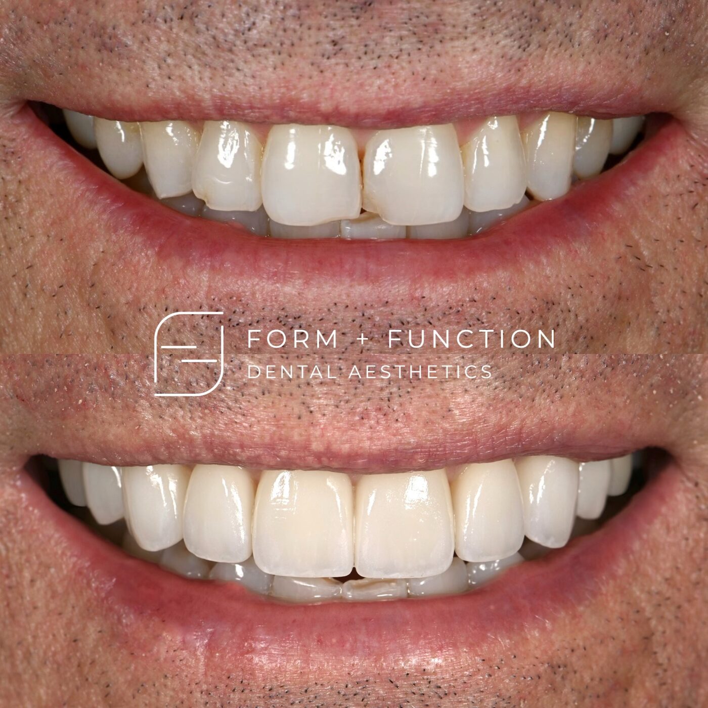 Before and after eight veneers, with the proportions of the front teeth reset against the lip line. Treated by Kevin Tan, DDS in Las Vegas.